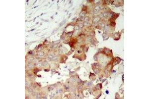 Immunohistochemical analysis of POTEB staining in human prostate cancer formalin fixed paraffin embedded tissue section. (POTEB antibody  (C-Term))