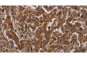Immunohistochemistry of paraffin-embedded Human liver cancer tissue using ATP2A1 Polyclonal Antibody at dilution 1:30 (ATP2A1/SERCA1 antibody)
