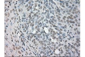 Immunohistochemical staining of paraffin-embedded Adenocarcinoma of colon tissue using anti-NEK6mouse monoclonal antibody. (NEK6 antibody)