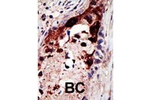 Formalin-fixed and paraffin-embedded human cancer tissue reacted with the primary antibody, which was peroxidase-conjugated to the secondary antibody, followed by AEC staining. (Epsin 2 antibody  (N-Term))