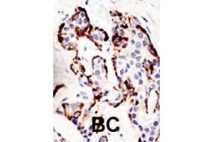 Formalin-fixed and paraffin-embedded human cancer tissue reacted with the primary antibody, which was peroxidase-conjugated to the secondary antibody, followed by DAB staining. (SUV39H2 antibody  (N-Term))