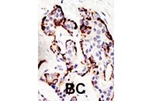 Formalin-fixed and paraffin-embedded human cancer tissue reacted with the primary antibody, which was peroxidase-conjugated to the secondary antibody, followed by DAB staining. (SUV39H2 antibody  (N-Term))