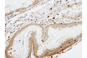 IHC-P Image Immunohistochemical analysis of paraffin-embedded human gastric cancer, using Coronin 1A, antibody at 1:100 dilution. (Coronin 1a antibody  (C-Term))