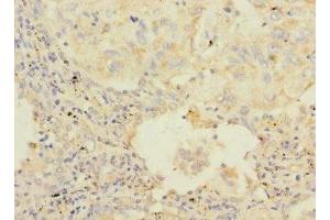 Immunohistochemistry of paraffin-embedded human lung cancer using ABIN7154845 at dilution of 1:100 (HAND1 antibody  (AA 16-215))
