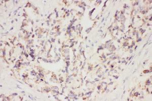 Anti-VEGF Picoband antibody,  IHC(P): Human Lung Cancer Tissue (VEGFA antibody  (AA 27-191))