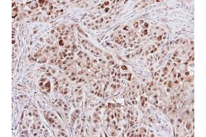 IHC-P Image Immunohistochemical analysis of paraffin-embedded A549 xenograft, using S6K2, antibody at 1:500 dilution. (RPS6KB2 antibody  (Center))