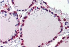 Human Thyroid (formalin-fixed, paraffin-embedded) stained with  antibody ABIN462276 followed by biotinylated secondary antibody, alkaline phosphatase-streptavidin and chromogen. (CRABP1 antibody  (AA 1-137))