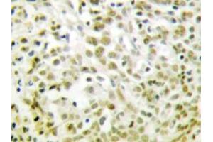 Immunohistochemistry analyzes of p53 antibody in paraffin-embedded human lung carcinoma tissue. (p53 antibody)