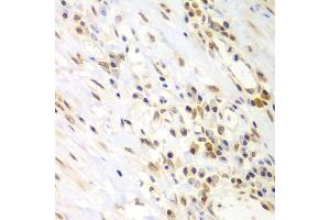 Immunohistochemistry of paraffin-embedded human gastric cancer using LHX4 antibody (ABIN5975324) at dilution of 1/100 (40x lens). (LHX4 antibody)