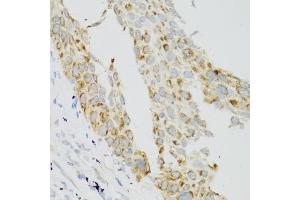 Immunohistochemistry of paraffin-embedded human lung cancer using TEK antibody.