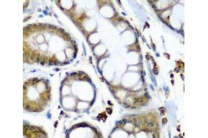 Immunohistochemistry of paraffin-embedded Human colon carcinoma using SECISBP2 Polyclonal Antibody at dilution of 1:200 (40x lens). (SECISBP2 antibody)