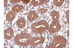 IHC-P Image Immunohistochemical analysis of paraffin-embedded human colon carcinoma, using USP8, antibody at 1:500 dilution. (USP8 antibody)