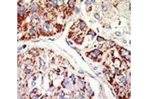 IHC analysis of FFPE human hepatocarcinoma tissue stained with the EZH1 antibody (EZH1 antibody  (AA 393-422))