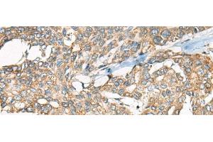 Immunohistochemistry of paraffin-embedded Human liver cancer tissue using YEATS2 Polyclonal Antibody at dilution of 1:55(x200) (YEATS2 antibody)