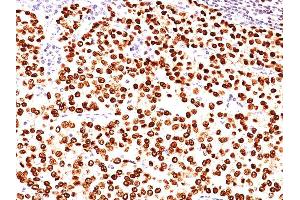 Formalin-fixed, paraffin-embedded human Breast Carcinoma stained with Progesterone Receptor Mouse Monoclonal Antibody (PR484). (Progesterone Receptor antibody)