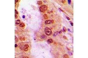 Immunohistochemical analysis of iNOS staining in human lung cancer formalin fixed paraffin embedded tissue section. (NOS2 antibody  (N-Term))