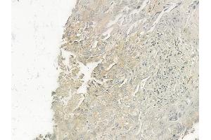 ABIN6262103 and ABIN6277371 at 1/100 staining human lung squamous cell carcinoma by IHC-P. (GRPR antibody  (Internal Region))