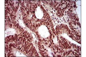 Immunohistochemical analysis of paraffin-embedded rectum cancer tissues using NBN mouse mAb with DAB staining.