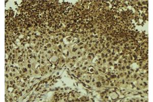 ABIN6278705 at 1/100 staining Human breast cancer tissue by IHC-P. (ZNF7 antibody  (Internal Region))