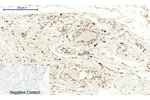 Immunohistochemical analysis of paraffin-embedded human breast tissue. (PTGS2 antibody  (AA 530-610))