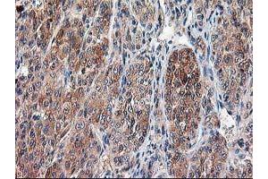Immunohistochemical staining of paraffin-embedded Carcinoma of Human liver tissue using anti-CAPN9 mouse monoclonal antibody. (Calpain 9 antibody)