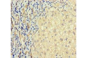 Immunohistochemistry of paraffin-embedded human liver cancer using ABIN7171548 at dilution of 1:100 (TAS2R41 antibody  (AA 205-234))