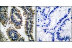 Immunohistochemistry analysis of paraffin-embedded human lung carcinoma, using STAT2 (Phospho-Tyr690) Antibody. (STAT2 antibody  (pTyr690))