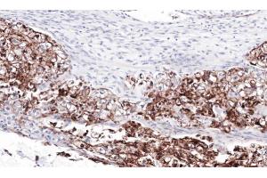 IHC-P Image Immunohistochemical analysis of paraffin-embedded human ovarian cancer, using FLRT1, antibody at 1:100 dilution. (FLRT1 antibody)