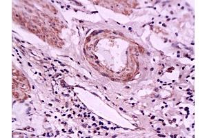 Formalin-fixed and paraffin embedded human gastric carcinoma tissue labeled with Anti-E-Selectin Polyclonal Antibody, Unconjugated (ABIN674244) at 1:200 followed by conjugation to the secondary antibody and DAB staining (Selectin E/CD62e antibody  (AA 501-612))