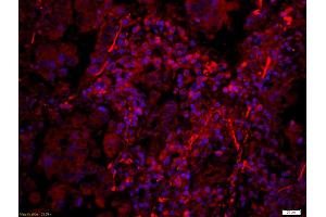 Formalin-fixed and paraffin-embedded human lung carcinoma labeled with Anti-Phospho-PERK(Thr980) Polyclonal Antibody, Unconjugated (ABIN744713) 1:200, overnight at 4°C, The secondary antibody was Goat Anti-Rabbit IgG, Cy3 conjugated used at 1:200 dilution for 40 minutes at 37°C. (PERK antibody  (pThr980))