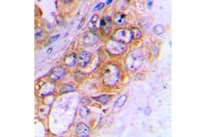 Immunohistochemical analysis of ABCB10 staining in human lung cancer formalin fixed paraffin embedded tissue section. (ABCB10 antibody  (Center))