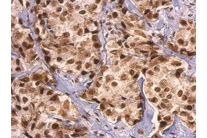 IHC-P Image GRB2 antibody detects GRB2 protein at nucleus on human breast carcinoma by immunohistochemical analysis.
