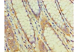 Immunohistochemistry of paraffin-embedded human colon cancer using ABIN7162957 at dilution of 1:100 (EHHADH antibody  (AA 1-723))
