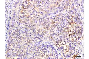 Formalin-fixed and paraffin embedded human flat moss tinea labeled with Anti-TGF-beta-1 Polyclonal Antibody, Unconjugated (ABIN724685) 1:200 followed by conjugation to the secondary antibody and DAB staining (TGFB1 antibody  (AA 351-390))