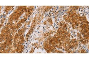 Immunohistochemistry of paraffin-embedded Human gasrtic cancer tissue using CENPE Polyclonal Antibody at dilution 1:50 (CENPE antibody)