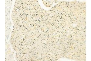 ABIN6260535 and ABIN6279822 at 1/100 staining human esophageal carcinoma by IHC-P.
