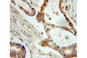 Immunohistochemistry of paraffin-embedded Pancreas cancer using NME1 antibody. (NME1 antibody  (C-Term))