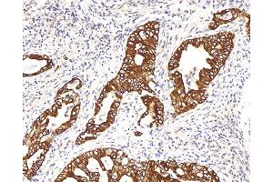 Immunohistochemistry analysis of paraffin-embedded human stomach cancer using CK-8 Polyclonal Antibody at dilution of 1:200. (KRT8 antibody)