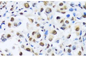 Immunohistochemistry of paraffin-embedded Human lung cancer using OTP Polyclonal Antibody at dilution of 1:100 (40x lens).