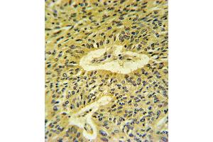 Smad7 Antibody (Center) (ABIN652239 and ABIN2840995) IHC analysis in formalin fixed and paraffin embedded lung carcinoma followed by peroxidase conjugation of the secondary antibody and DAB staining. (SMAD7 antibody  (AA 195-224))