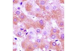 Immunohistochemical analysis of FURIN staining in human liver cancer formalin fixed paraffin embedded tissue section. (FURIN antibody)