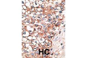 Formalin-fixed and paraffin-embedded human hepatocellular carcinoma tissue reacted with GJA9 polyclonal antibody  , which was peroxidase-conjugated to the secondary antibody, followed by AEC staining. (GJA9 antibody  (C-Term))