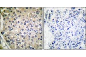 Immunohistochemistry analysis of paraffin-embedded human breast carcinoma, using CPI17 alpha (Phospho-Thr38) Antibody. (CPI-17 antibody  (pThr38))