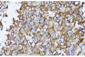 Immunohistochemistry of paraffin-embedded Human esophageal cancer using TBCB Polyclonal Antibody at dilution of 1:100 (40x lens). (TBCB antibody)