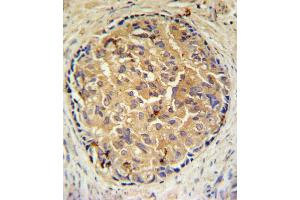 SRD5A3 Antibody (C-term) (ABIN651469 and ABIN2840258) IHC analysis in formalin fixed and paraffin embedded human prostate carcinoma followed by peroxidase conjugation of the secondary antibody and DAB staining.