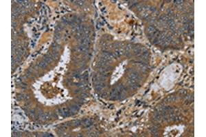 The image on the left is immunohistochemistry of paraffin-embedded Human colon cancer tissue using ABIN7130524(PAEP Antibody) at dilution 1/60, on the right is treated with fusion protein.
