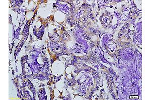Formalin-fixed and paraffin embedded human colon carcinoma labeled with Rabbit Anti-MMP-7 Polyclonal Antibody, Unconjugated (ABIN668451) at 1:200 followed by conjugation to the secondary antibody and DAB staining.
