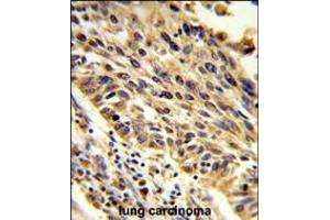 Formalin-fixed and paraffin-embedded human lung carcinoma reacted with TRIP13 Antibody , which was peroxidase-conjugated to the secondary antibody, followed by DAB staining. (TRIP13 antibody  (N-Term))