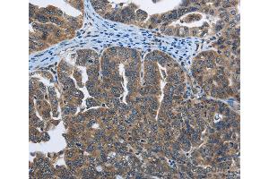 Immunohistochemistry of Human cervical cancer using SYT3 Polyclonal Antibody at dilution of 1:40