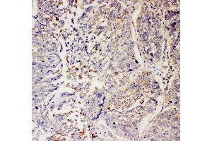 Anti-SLC9A2 antibody, IHC(P) IHC(P): Human Lung Cancer Tissue (SLC9A2 antibody  (C-Term))